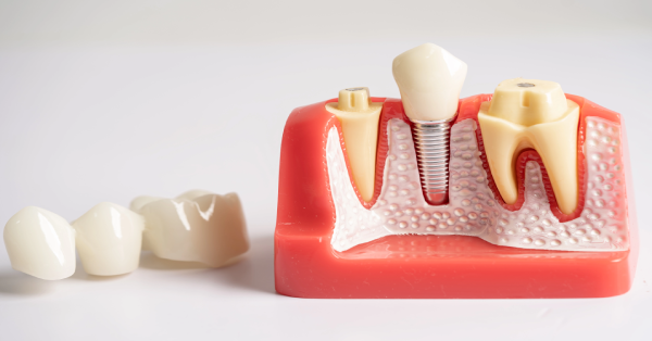 Preventing Bone Loss with Dental Implants : A Lifelong Solution